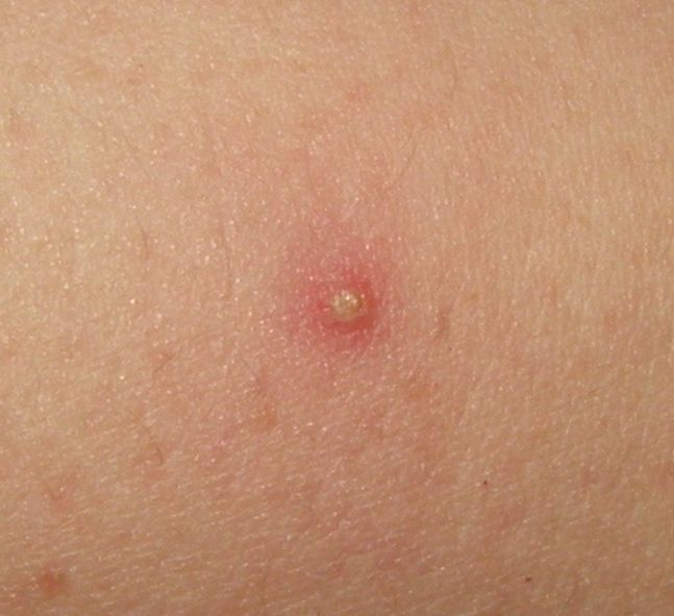 Бактериальный фолликулит