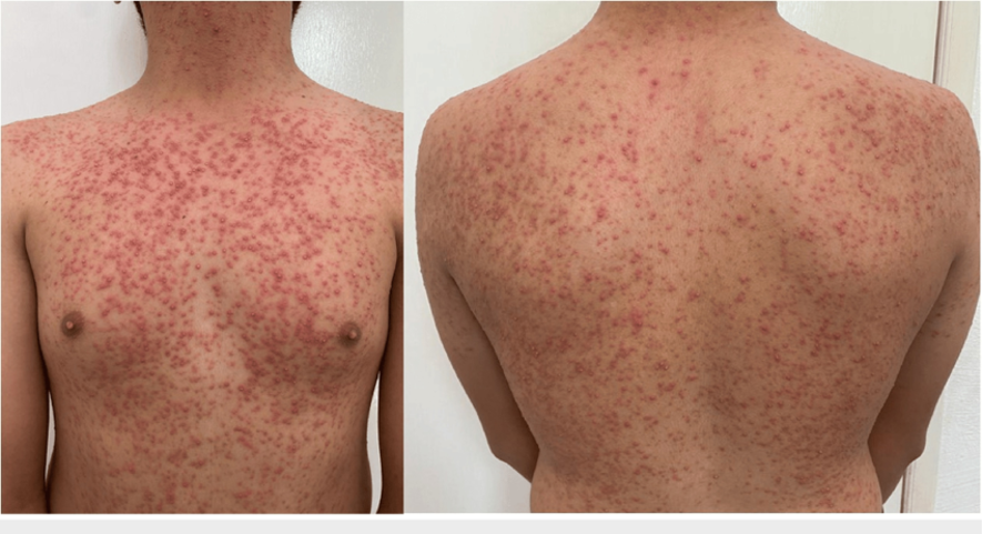 Грибковый (Malassezia) фолликулит